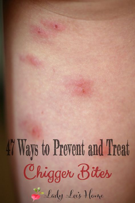 applied Chigger Bite Remedy, Red Bugs, Bug Bites Remedies, Bite Relief, Bug Bites, Homemade Remedies, Diy Natural Products, Natural Medicine, Pest Control