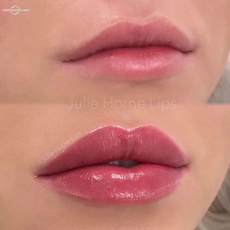 Keyhole Lips, Lip Fillers Juvederm, Restylane Lips, Lips Fillers, Lip Permanent Makeup, Lips Shape, Lips Inspiration, Permanente Make-up, Face Fillers