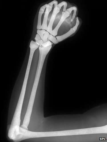 X-ray of clenched fist Hand Structure, Evolution Of Human, Skeleton Arm, Clenched Fist, Human Hand, Doja Cat, Bbc News, Face Masks, Bbc