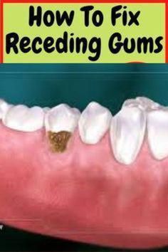 Some common reason for receding gums are Improper floosing, brushing teeth too hard or the wrong way, Tobacco use, abnormal tooth position #WhatsOralCare Tooth Scaling, Fix Receding Gums, Tooth Decay Remedies, Tooth Repair, Heal Cavities, Teeth Health, Receding Gums, Dental Procedures, Tooth Brush