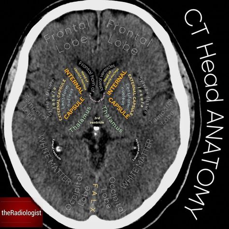 The Radiologist on Instagram: “Check out this axial slice of a non-contrast CT head at the level of the basal ganglia⁣ ⁣ CT HEAD⁣ 👨🏽‍💻The number of head CTs we do in…” Mri Brain, Radiology Student, Basal Ganglia, Occipital Lobe, Head Anatomy, Airway Management, Frontal Lobe, Nursing Mnemonics, Limbic System