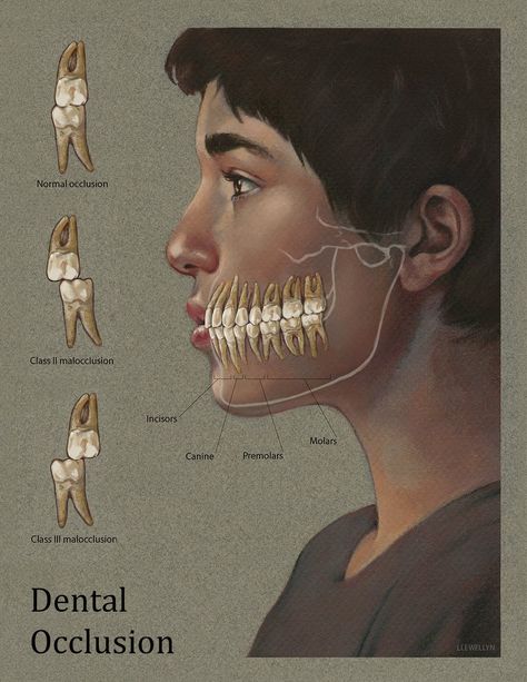 Occlusion classifications Dental Assistant Study, Dental Hygiene Student, Dental Images, Dental World, Dental Videos, Kedokteran Gigi, Dental Hygiene School, Dentistry Student, Dental Anatomy