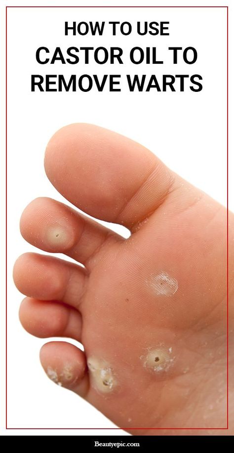 Planters Wart, What Causes Warts, Warts On Hands, Warts On Face, Home Remedies For Warts, How To Remove Warts, Warts Remedy, Remove Warts, Get Rid Of Warts