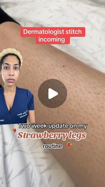 Dr. Neera Nathan on Instagram: "How to treat keratosis pilaris (“strawberry legs” or “chicken skin”) like a dermatologist.  Keratosis pilaris (KP) usually presents as rough, bumpy skin on the arms and/or legs and is pretty common. If you are bothered by your KP, here’s a three step routine I swear by as a dermatologist to help get rid of those bumps:  1. Use a gentle exfoliant in the shower 3-4x per week. Avoid loofahs which are a breeding ground for bacteria and just make skin more irritated. Try the KP Bump Eraser from First Aid Beauty which contains an AHA blend and gentle mechanical exfoliants to loosen trapped hairs and soften rough skin.  2. Apply glycolic acid on a cotton pad 3-4x per week. Glycolic acid is both a keratolytic (helps remove excess skin) and humectant (draws in moistu Red Bumps On Legs How To Get Rid Of, Strawberry Arms Remedy, Chicken Skin Remedy, How To Get Rid Of Strawberry Legs Fast, Strawberry Legs Remedy, Kp Skin, Keratosis Pilaris Remedy, Skin Boil, Kp Bump Eraser