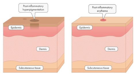 Post Inflammatory Erythema, Pimple Causes, Different Types Of Acne, Laser Skin Resurfacing, Post Inflammatory Hyperpigmentation, Acne Vulgaris, Medical Aesthetics, Types Of Acne, Skin Resurfacing