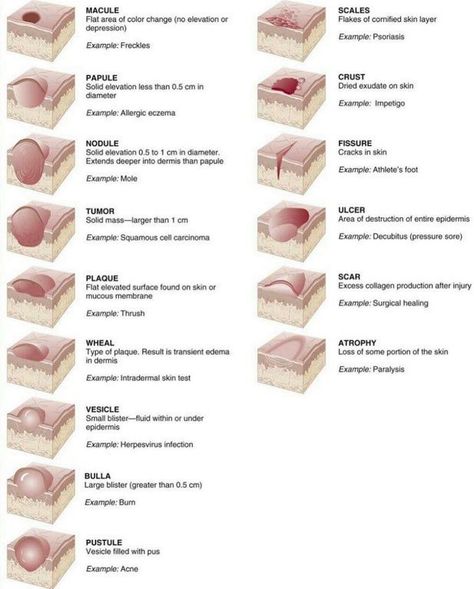 Types of Skin Lesions Charting For Nurses, Skin Lesions, Skin Anatomy, Esthetician School, Medical Mnemonics, Human Body Organs, Integumentary System, Vet Medicine, Nurse Study Notes