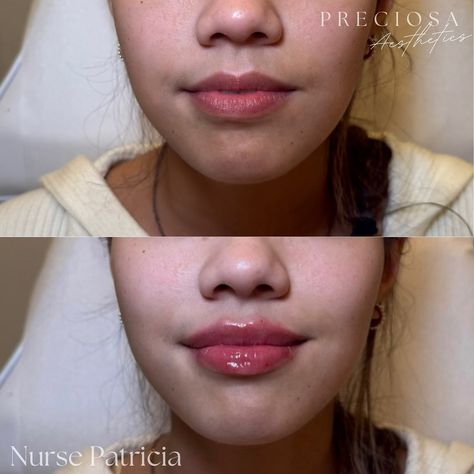 Signature Lips by Preciosa 💉👄 We used half a syringe to achieve these stunning results 😍 Book an appointment today! 🤍 📱 647-984-8802 🖥️ www.PreciosaAesthetics.com 📧 Preciosa.Aesthetics@hotmail.com 📍 102 Lakeshore Road East, Mississauga #lipfiller #filler #lips #beauty #aesthetics #botox #dysport #nucieva #chinfiller #cheekfiller #mississauga #portcredit #toronto #oakville #nurse #nurseinjector #beforeandafter Filler Lip, Aesthetic Treatments, Chin Filler, Port Credit, Korean Lips, Cheek Fillers, Lip Fillers, Book An Appointment, Skin Care Treatments