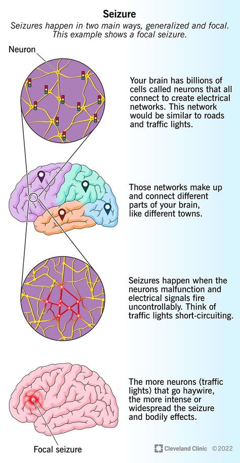 Myoclonic Seizures, Seizures Non Epileptic, Status Epilepticus, Absence Seizures, Types Of Seizures, Seizures Awareness, Nursing School Essential, Brain Stimulation, Brain Facts