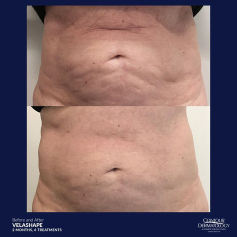 Experience a reduction of several inches in areas such as the thighs, outer hip, abdomen, love handles, saddlebags and buttocks with Velashape.   #contourderm #Jochenmd #bodycontouring #fatloss #velashape #cellulite #botox #fillers #skin #dermatolog #laserfotona #depilacionlaserdefinitiva #celulitis #teamcelan #beauty #spa #skintightening #sublime #fatreduction Brazilian Buttlift Surgery Results, Lower Body Lift Surgery Before And After, Laser Stretch Mark Removal, Lipo Suction Before And After, Lipo Suction Tummy Tucks, Botox Fillers, Fat Reduction, Love Handles, Skin Tightening