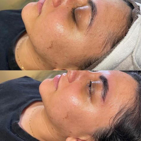 My beautiful client got a dermaplane facial, lash lift, and brow lam & tint! The before and afters really show how dermaplaning exfoliates the top layer of skin to reveal the glow from underneath! You can also see the texture change from before and after on the forehead and cheeks to a smooth finish! #esthetician #dermaplaning #estheticianlife #dermaplaningfacial #glowfacial #laslifting #browlamination #browshaping #browlift #browlam Dermaplaning Before And After, Hydrafacial Before And After, Dermaplane Facial, Facial Before And After, Dermaplaning Facial, Brow Lift, Brow Lamination, Brow Shaping, Layers Of Skin