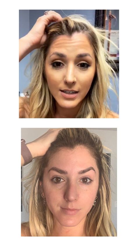 Before And After Botox Pictures, Botox Pictures, Botox Brow Lift, Botox Before And After, Botox Lips, Botox Cosmetic, Botulinum Toxin, Cosmetic Dermatology, Botox Fillers