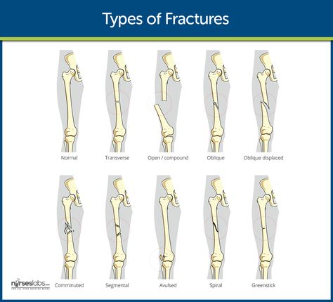 There are several kinds of fracture that may occur in a bone: Fracture Types, Cen Review, Musculoskeletal Disorders, Surgical Technologist Student, Types Of Fractures, Emt Study, Orthopedic Nursing, Medical Terminology Study, Nursing Cheat