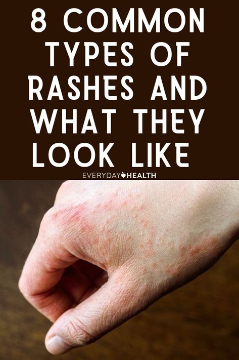 Is your skin itchy, dry, blistering, or red? Do you have rashes that come and go? You may have one of these common skin conditions. Skin Rash Remedies, Heat Rash Remedy, Skin Rashes Pictures, Allergic Reaction Rash, Home Remedies For Rashes, Rash On Hands, Types Of Skin Rashes, Itchy Skin Rash, Itchy Skin Remedy