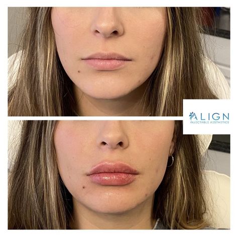 Small Mouth With Lip Injections, Sarah Cameron Lip Filler, Heavy Upper Lip Filler, Natural Lips Filler, Bottom Heavy Lip Filler, Lip Filler Heavy Upper Lip, Lip Filler Bottom Lip Bigger, 1ml Lip Filler Small Lips, Nessa Barrett Lip Filler