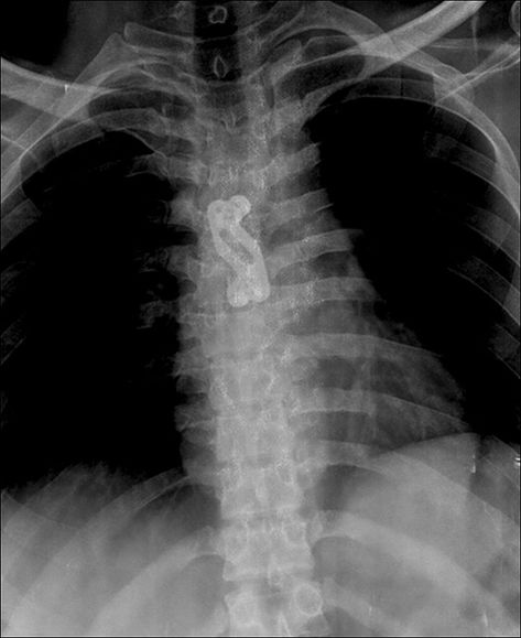 Iliac Crest, Cancellous Bone, Vascular Surgery, Activities Of Daily Living, Mri Scan, Coronary Arteries, Ct Scan, Chest Pain, Pain Relief