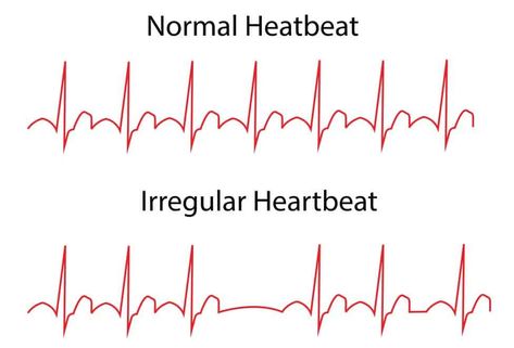 Heart arrhythmias can be harmless at first or they may end up causing your heart to flutter and cause your pulse to speed up.... Learn more Human Cells, Parts Of The Heart, Congenital Heart Defect, Heart Palpitations, Congenital Heart, Atrial Fibrillation, Heart Rhythms, Heart Muscle, Coronary Arteries