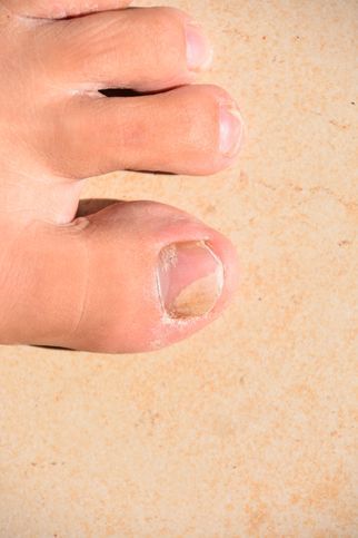 Staying one step ahead of toenail fungus - Harvard Health Toenail Fungal Infection, Natural Antifungal, Nail Infection, Nail Fungus Remedy, Fungal Nail, Tongue Health, Ingrown Toe Nail, Striped Nails, Toenail Fungus