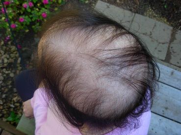 Pre Chemo Haircut, Chemo Curls, Hair Growth After Chemo, Chemo Care, Chemo Hair, Help Hair Grow, Diy Haircut, Hair Due, Lost Hair