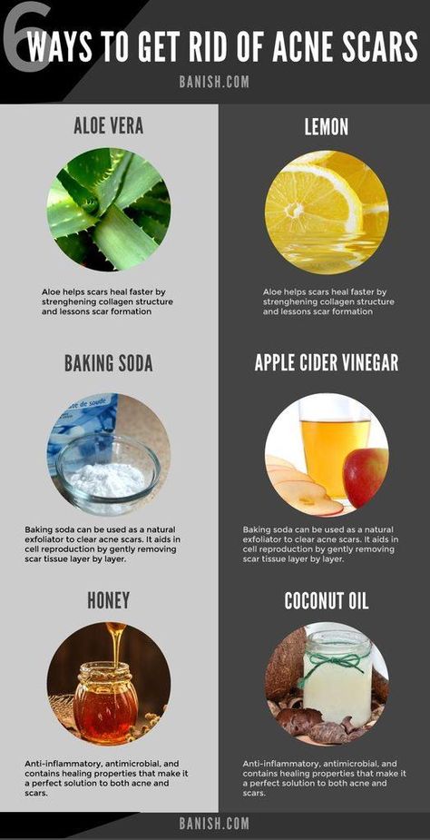 Getting Rid Of Scars, Different Types Of Acne, Natural Baking, Cold Sores, Natural Acne Remedies, Get Rid Of Acne, Natural Acne, Cold Sores Remedies, Rid Of Acne