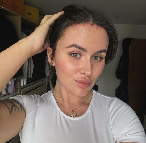 A Woman Decides to Undergo Forehead Reduction Surgery After Being Shamed for It Forehead Reduction Surgery, Forehead Reduction, Facial Proportions, Reduction Surgery, Grow Instagram, Post Surgery, Plastic Surgeon, Years Younger, School Days