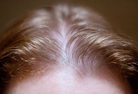 "Forty percent of people who experience temporary or long term hair loss are women." #hairloss #hair Thinning Hairline, Thining Hair, Losing Hair, Mineral Deficiency, Dunner Wordend Haar, Luxury Hair Care, Loss Hair, Promote Hair Growth, Male Pattern Baldness