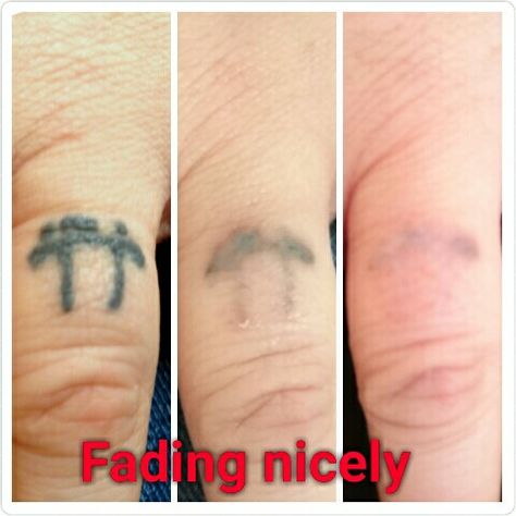 This very dark tattoo on my client's finger may only be small but it's been flooded with ink. www.the-missing-ink.co.uk  #GetRidOfYourInk #DoingItProperly #LovingTheFade #TattooRegret #TattooRemoval #LaserTattooRemoval #TheMissingInk #Woodley #Stockport #Manchester #Cheshire #NorthWest No Regrets Tattoo, Finger Hands, Laser Tattoo Removal, Tattoo Removal, Progress Pictures, Dark Tattoo, Paw Print Tattoo, Hand Tattoos, Tattoos