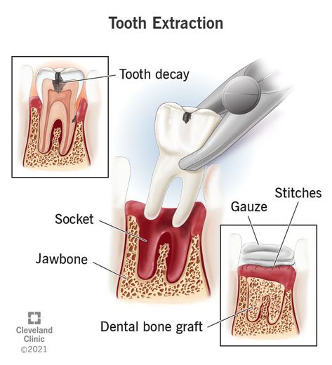 Teeth Extraction, Facial Aesthetic, Dental Animation, Dental Extraction, Medical Animation, Dental Art, Tooth Extraction, Medical Health, Aesthetic Clinic