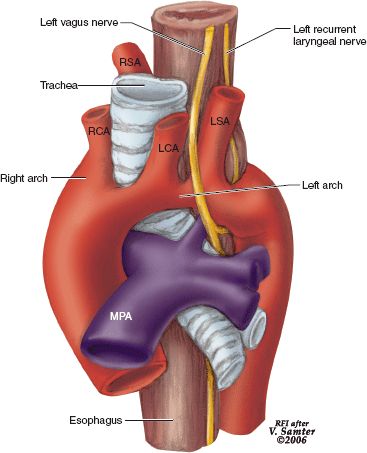 Double aortic arch Echo Sonography, Aortic Arch, Heart Anatomy, Nursing School Notes, Vagus Nerve, Nursing Education, Medical Knowledge, Invisible Illness, Cardiology