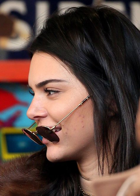 Kendall Jenner Acne, Paris January, Kendall Jenner Face, Kendall Jenner Icons, Kendall Jenner Makeup, Celebrity Acne, Jenner Photos, Kendall Jenner Photos, Acne Treatments