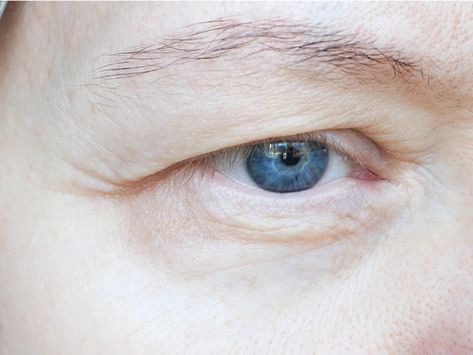 It can make you look younger and also help with your eyesight! The post Hooded eyes, droopy eyelids – what can be done? appeared first on Lifestyle Guide To Moving To & Living in Singapore - Expat Living. Hooded Eyes Men, Hooded Eye Surgery, Mid Face Lift, Retina Surgery, Saggy Eyelids, Droopy Eyelids, Laser Eye Surgery, Droopy Eyes, Fat Grafting