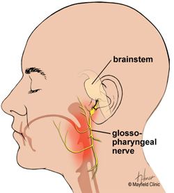 Nerves for tactile sensitivity are trigeminal facial nerves, glossopharyngeal and vegus cranial nerves. Glossopharyngeal Neuralgia, Glossopharyngeal Nerve, Occipital Neuralgia, Throbbing Headache, Throat Pain, Facial Nerve, Cranial Nerves, Medical School Essentials, Brain Surgery