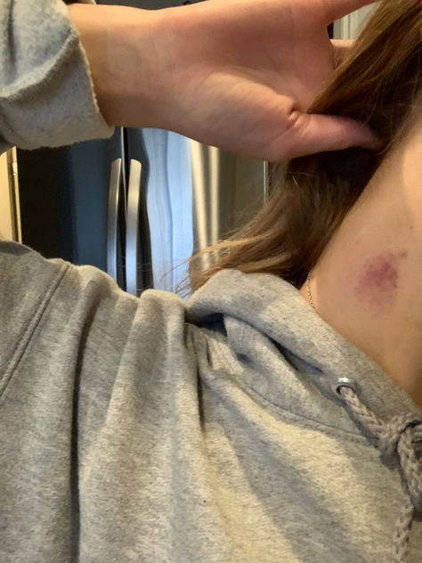 Hicks On Neck Girl, Hickies Neck Snapchat, Hickey Girls, Hickey Neck Aesthetique, Neck Full Of Hickeys, Hicks On Neck, Hickies Neck, Fake Injury, Couple Goal