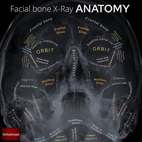 the Radiologist | Radiology on Instagram: "Occipito-mental radiograph of the facial bones⁣⁣ ⁣⁣ 👨🏽‍💻The facial bone X-ray is being replaced with CT in many places but in some places around the world remains first line in facial trauma. It can be a confusing film to assess with so much opportunity for composite shadowing - it is important to employ a robust system to assess for fractures⁣⁣ ⁣⁣ 👨🏽‍💻In nasal bone fractures (most common), mandible, zygoma and orbital fractures we cover over 98% Xray Drawing, Radiography Student, Radiology Schools, Medical Radiography, Radiologic Technology, Radiology Student, Radiology Technician, Radiology Imaging, Facial Bones