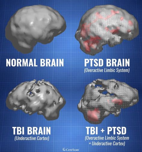 Normal brain Vs.  PTSD & TBI Brains. Hyperbaric Oxygen Therapy, Brain Surgeon, Brain Images, Brain Facts, Brain Anatomy, Brain Surgery, Brain Damage, Mental And Emotional Health, Brain Health