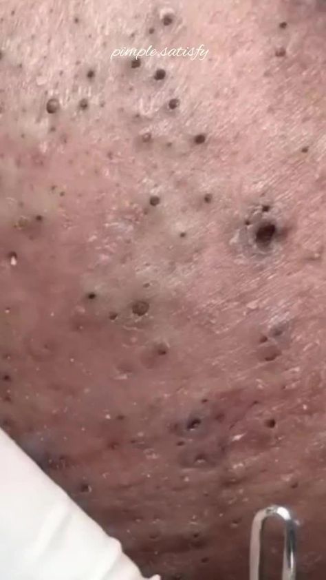 Huge Blackheads, Clear Skin Routine, Blackhead Extraction, Potato Juice, Exfoliating Pads, Acne Removal, Home Remedy For Cough, Diy Facial, Get Rid Of Blackheads