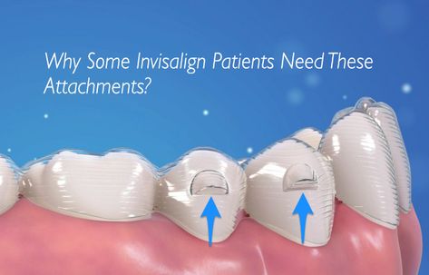 Find Out Why Some Invisalign Users Need Attachments Cleaning Invisalign Trays, Invisalign Tips And Tricks, Invisalign Before And After, Invisalign Aesthetic, Invisalign Attachments, Invisalign Hacks, Permanent Retainer, Invisalign Aligners, Dental Bonding