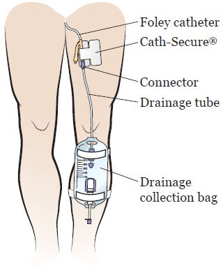 Cna Study Guide, Urinary Catheterization, Catheter Bag, Prostate Surgery, Foley Catheter, Patient Education, Leg Bag, After Surgery, Patient Experience