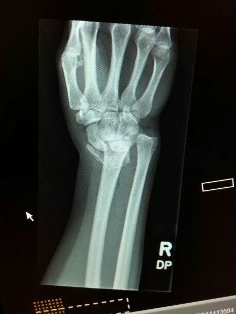 My own x ray.  Fracture dislocation. Same injury to both wrists though my right was worse. Specialists said they were the worst wrist injuries they had seen. Injury Aesthetic, Wrist Injuries, Wrist Injury, Cinta Quotes, Aesthetic Stuff, Reminder Quotes, Big Boy, X Ray, The Worst