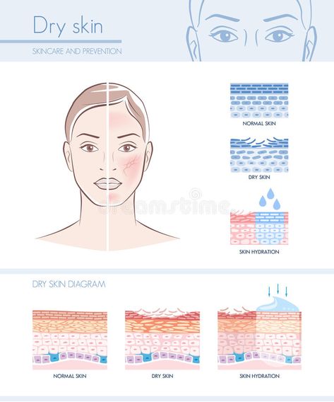 Dry skin. Hydration infographic with skin diagram; skincare and beauty concept , #SPONSORED, #Hydration, #infographic, #Dry, #skin, #beauty #ad Skin Diagram, Skincare Infographic, Making Skin Care Products, Types Of Facials, Tropic Skincare, Hydration Serum, Popular Skin Care Products, Dry Skin Care Routine, Skin Advice