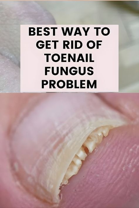 fungal nail remedies Homemade Nail Polish, Fungal Infection Remedies, Toenail Health, Nail Remedies, Toenail Fungus Remedies, Nail Infection, Fungal Nail, Ingrown Toe Nail, Toenail Fungus