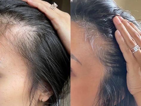 oh hey mama hair before and after Hair Before And After, Hair Regrowth Tips, Pregnancy Hair, Sugar Bear Hair, Dandruff Solutions, Mama Hair, Before And After Hair, My First Baby, Increase Hair Growth