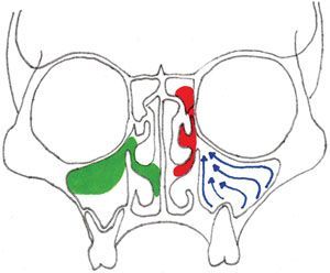 Figure 1 Acute Sinusitis, Sinus Drainage, Paranasal Sinuses, Maxillary Sinus, Nasal Obstruction, Chronic Sinusitis, Nasal Septum, Nasal Decongestant, Squamous Cell