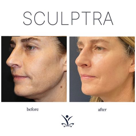 Sculptra Before And After Faces, Sculptra Before And After, Natural Filler, Sculptra Aesthetic, Botox Results, Face Rejuvenation, Skin Tightening Procedures, Botox Before And After, Face Fillers