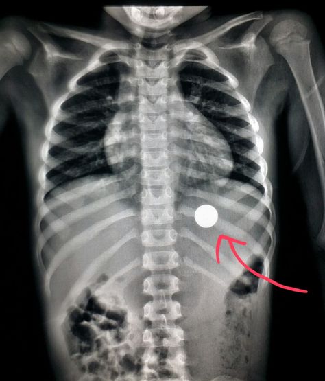 #Abdomen #xray shows a #penny the #child #swallowed in his #stomach. #radiologist #radiology #pain Abdomen Xray, Heart Xray, Healthy Heart, A Penny, Radiology, Heart Healthy, X Ray, Penny, Quick Saves