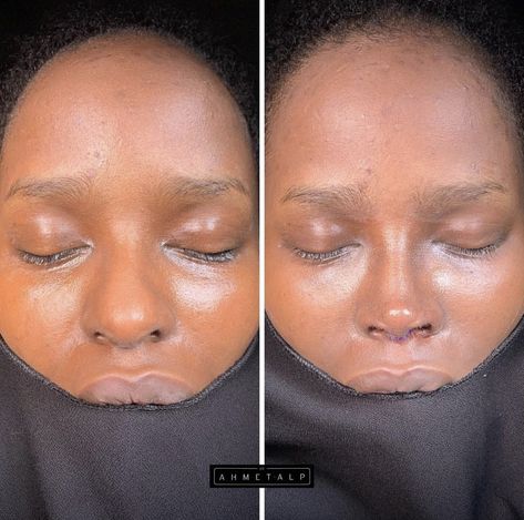 Nose Plastic Surgery, Nose Surgery Rhinoplasty, Ethnic Rhinoplasty, Rhinoplasty Nose Jobs, Face Surgery, Pretty Nose, Wide Nose, Beautiful Freckles, Perfect Nose