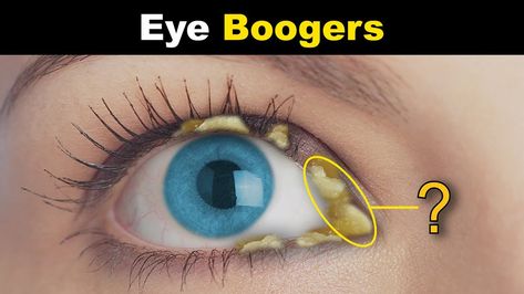 Learn about the common causes of eye boogers and discover simple tips to keep your eyes clear and comfortable. - #Causesofeyeboogers #Clearingeyegunk #Crustineyes #Eyecrud #Eyecrust #Eyecrusties #Eyedebris #Eyedirt #Eyedischarge #Eyegoop #Eyegunk #Eyematter #Eyemucous #Eyemucus #Eyeresidue #Eyesecretion #Eyesecretions #Howtopreventeyeboogers #Managingeyedischarge #Morningeyedischarge #Rheum #Sleepcrust #Sleepintheeyes #Treatmentforeyecrust How To Improve Eyesight In A Week, Good For Eyesight, Strengthen Eyesight, Goopy Eyes, Crusty Eyes, Eye Infestation Pressure, Improving Eyesight, Chronic Dry Eye, Eye Corner