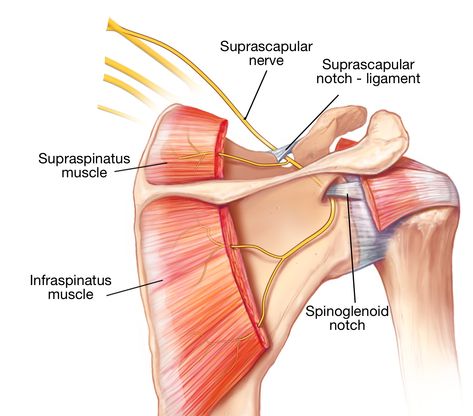 A tiny nerve in the shoulder can create so much trouble! All you need to know about the suprascapular nerve - Shoulder & Elbow Supraspinatus Muscle, Infraspinatus Muscle, Nerve Conduction Study, Nerve Anatomy, Med School Study, Nerve Problems, Rotator Cuff Tear, Nerve Fiber, Muscle Atrophy