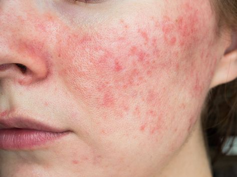 Everything You Need To Know About Rosacea | Chatelaine Remove Acne, Skin Clinic, Skin Care Acne, Holistic Healing, Skin Concern, Dermatology, Skin Problems, Acne Prone Skin, Skin Conditions