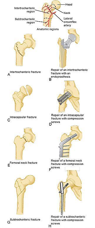 intertrochanteric fracture ROSH - Google Search Orthopedic Nursing, Surg Tech, Surgical Technician, Radiology Student, Hip Fracture, Operating Room Nurse, Surgical Technologist, Surgical Nursing, Surgical Tech