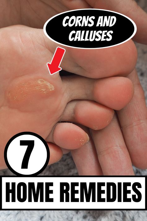 Remove Calluses On Feet Remedies, Diy Callus Remover, How To Remove Calluses From Foot, Calloused Feet Remedy, How To Get Rid Of Calluses On Feet Fast, Calluses On Feet Remedies, Foot Soak For Calluses, Callus Remover Diy, Get Rid Of Corns